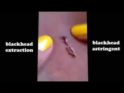 Pimple Popper&39;s blackhead-removing set. . Pulling out whiteheads with tweezers